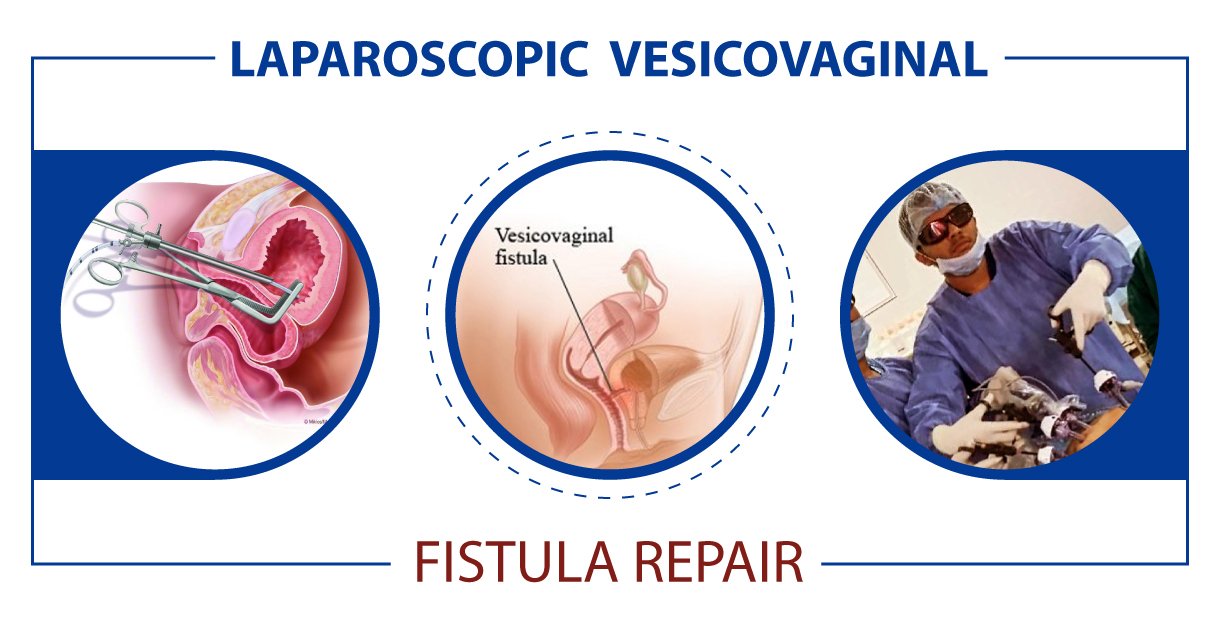 Laparoscopic VVF Repair