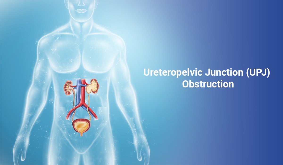An Overview Of Ureteropelvic Junction Upj Obstruction