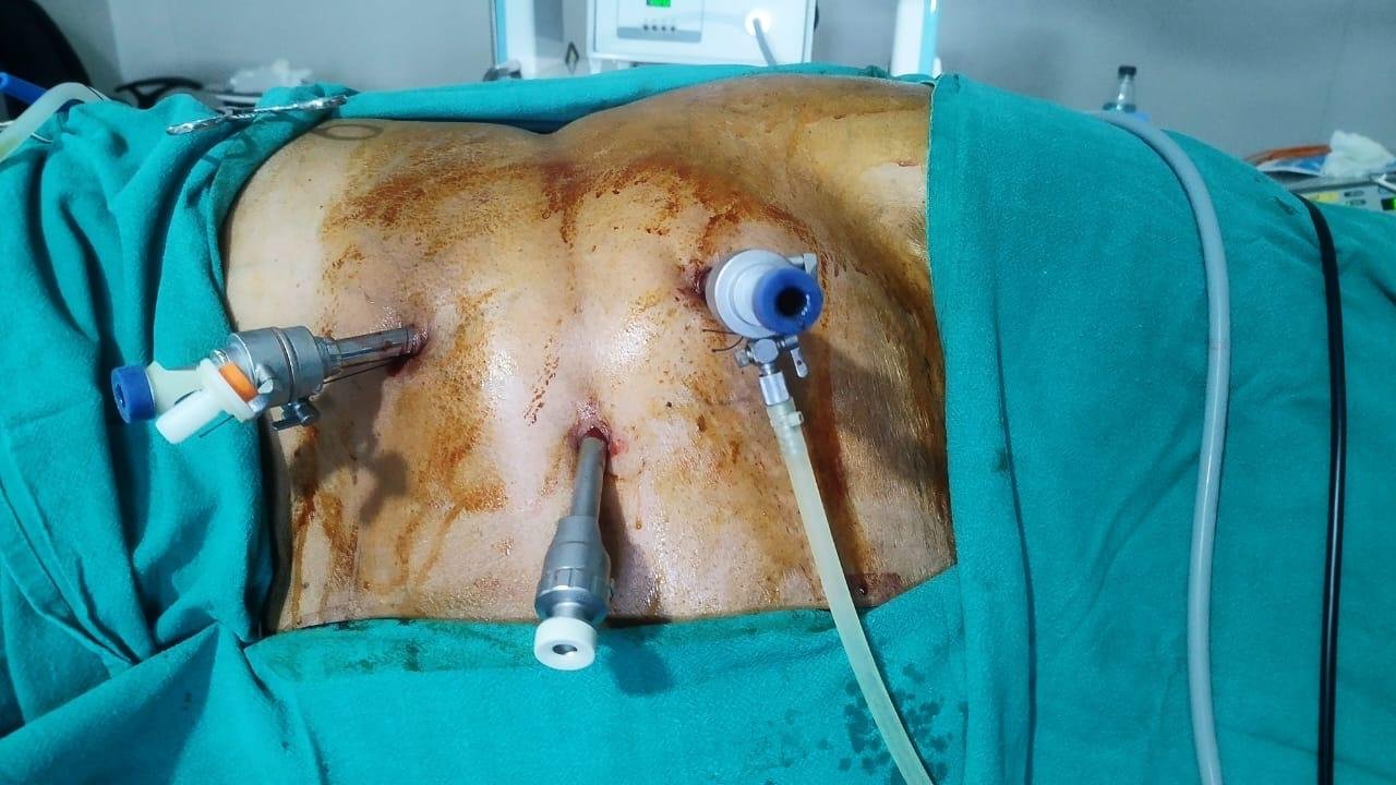 Laparoscopic Radical Nephrectomy