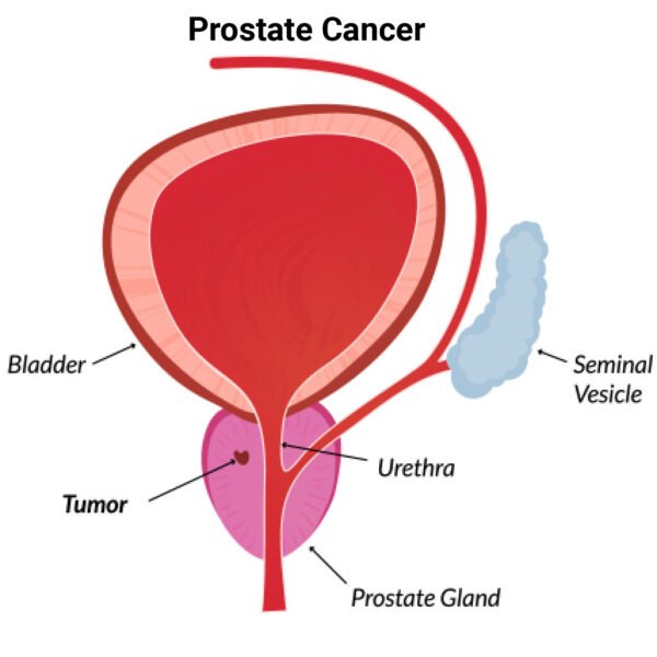 Prostate Cancer: Understanding the Basics and Facts You Need to Know