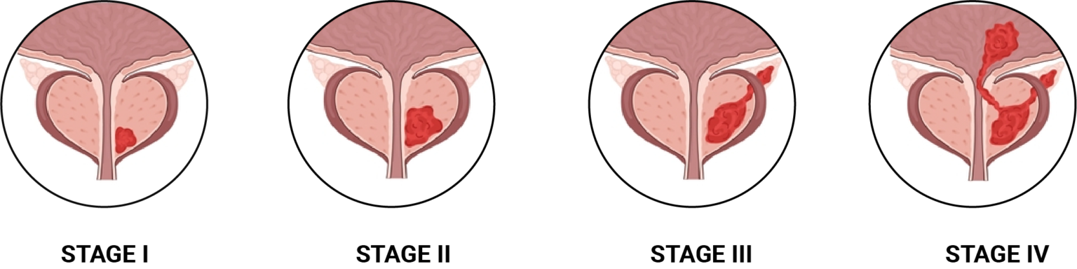 Prostate Cancer: Understanding the Basics and Facts You Need to Know