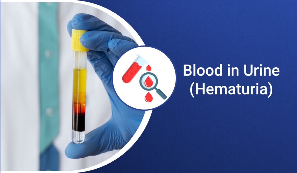 Blood In Urine (Hematuria): Explain By Leading Urologist