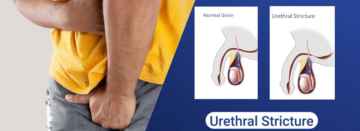 Urethral Stricture
