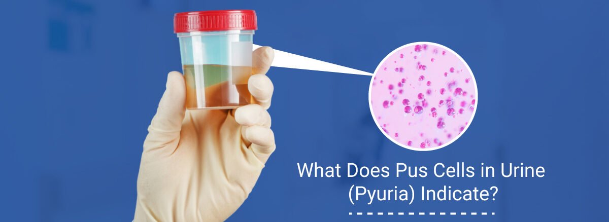 Pus Cells in Urine pyuria