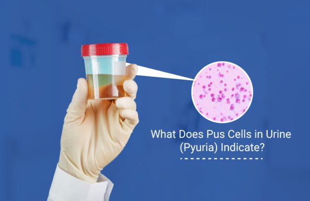 Pus Cells in Urine pyuria