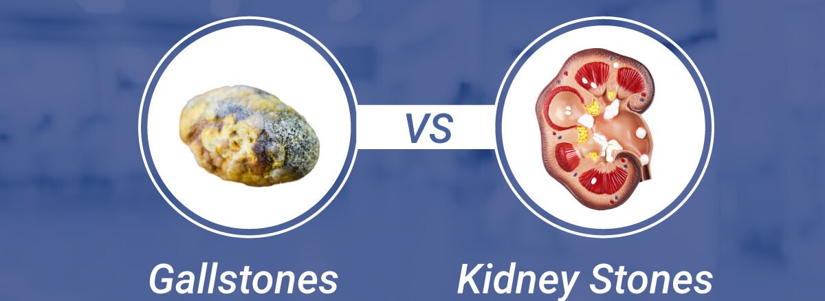 Gallstones vs Kidney Stones