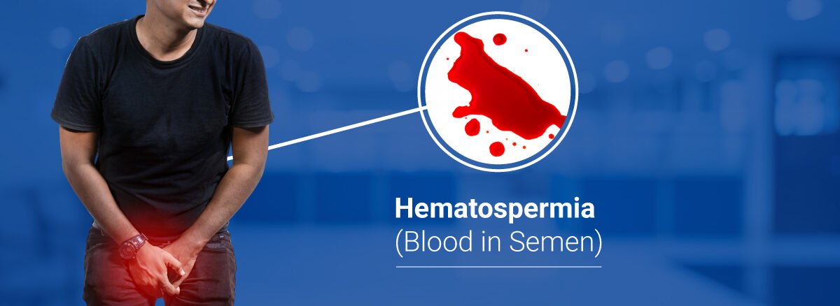 Hematospermia (Blood in Semen)
