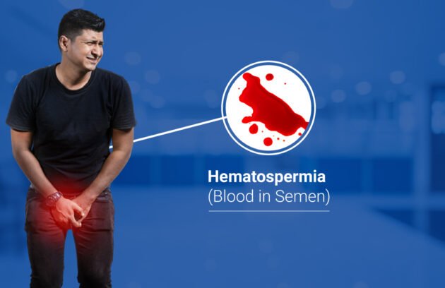 Hematospermia (Blood in Semen)