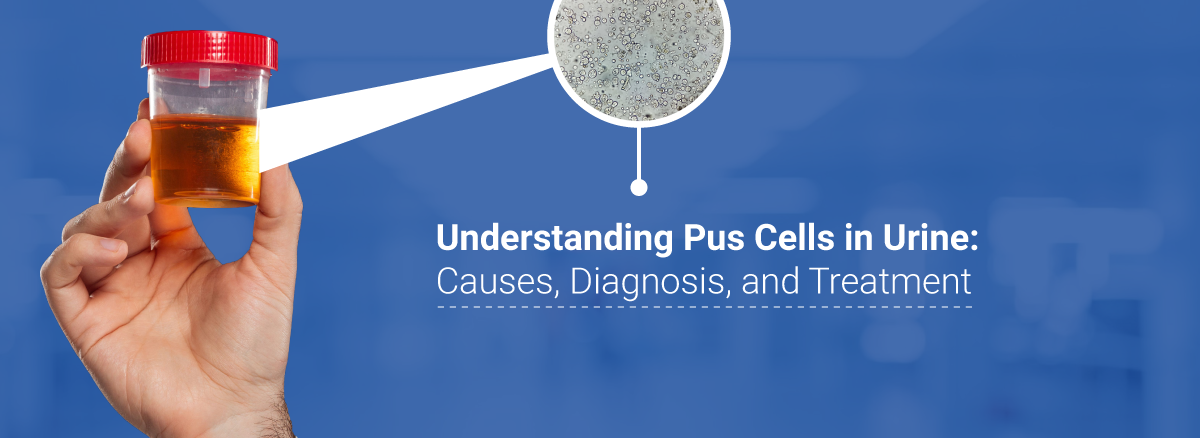 Understanding Pus Cells in Urine
