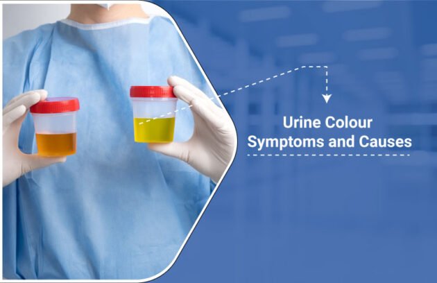 Causes of urine discoloration-Urologist in Dhanbad