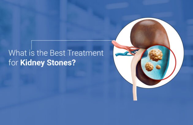 Kidney Stone Specialist in Dhanbad