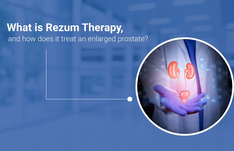 Rezum therapy for an enlarged prostate