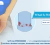 What Is Penile Cancer?