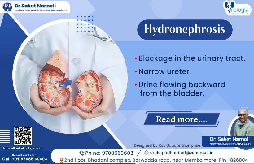 Hydronephrosis