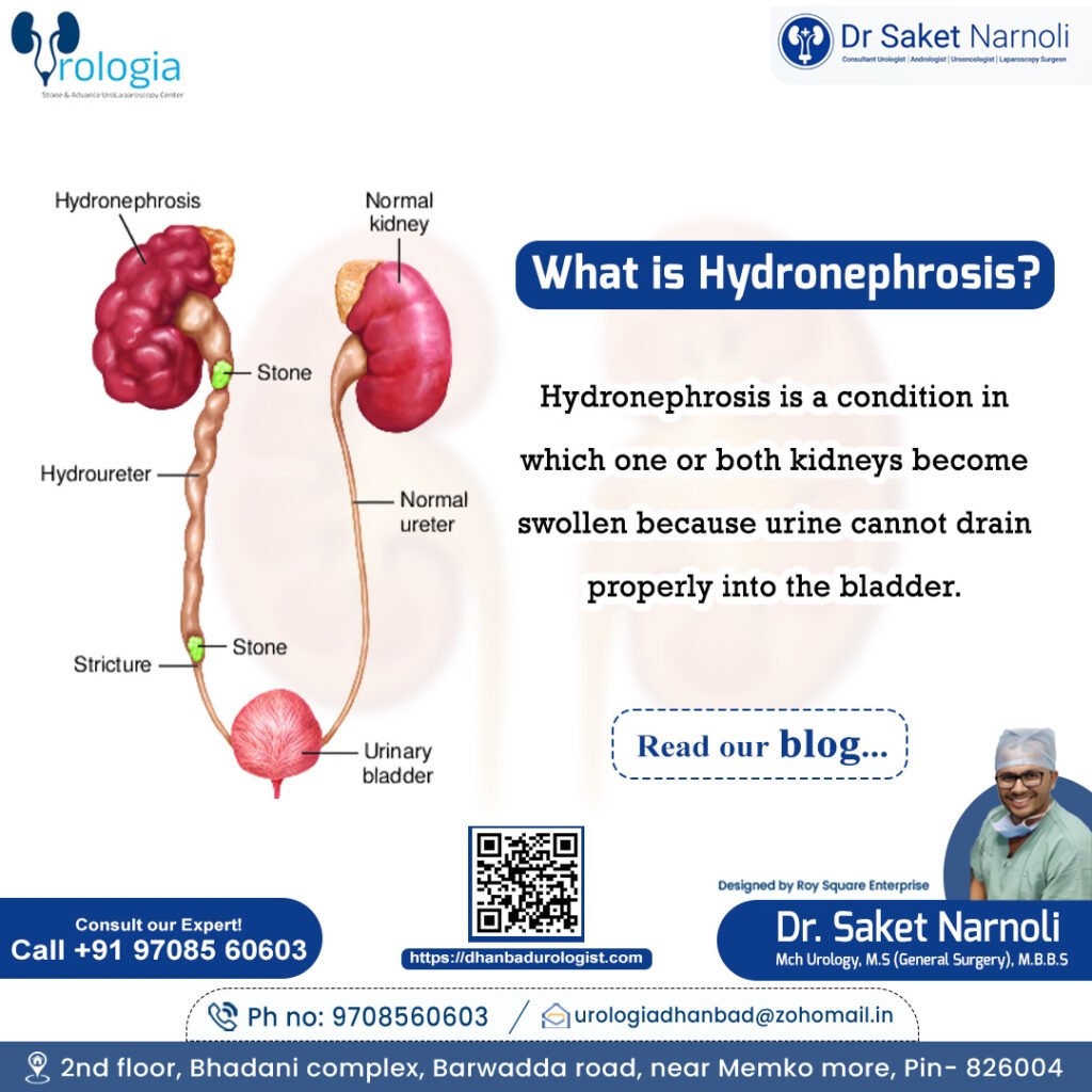 What is Hydronephrosis?