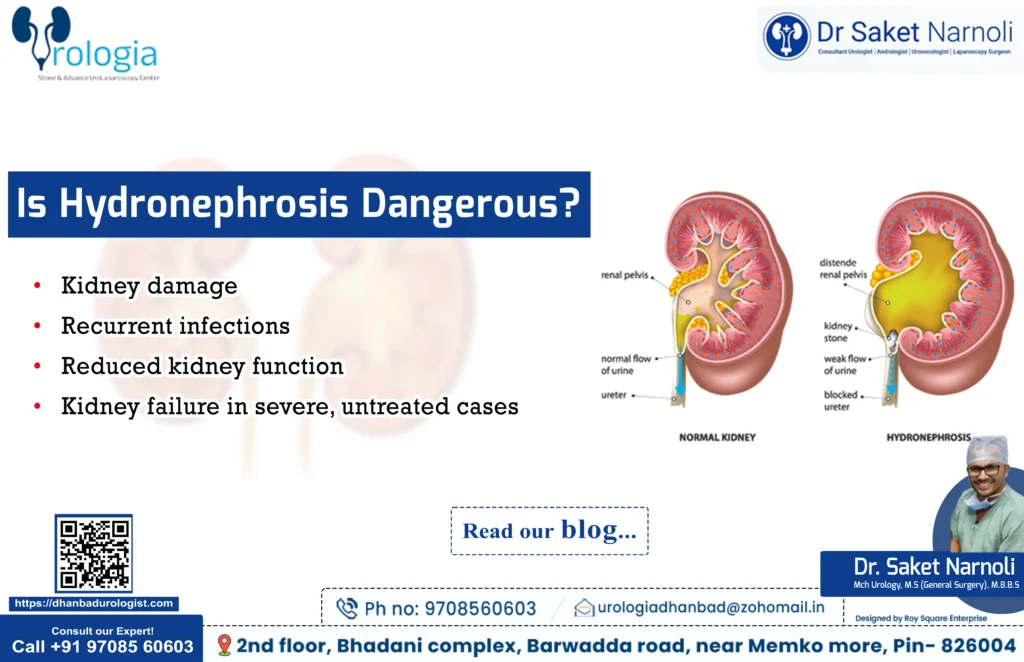 Is Hydronephrosis Dangerous?