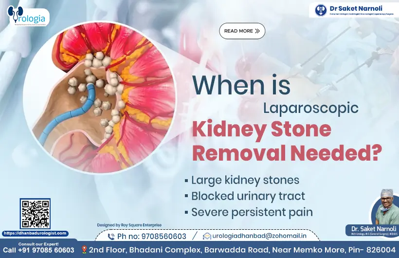 When is Laparoscopic Kidney Stone Removal Needed?