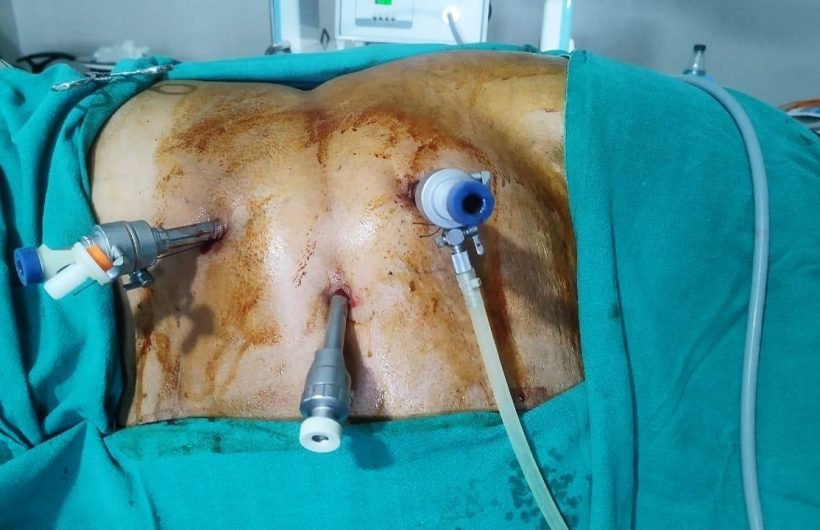 Laparoscopic Radical Nephrectomy