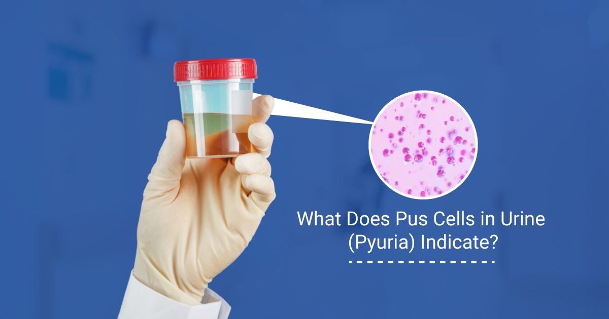 Pus Cells in Urine pyuria