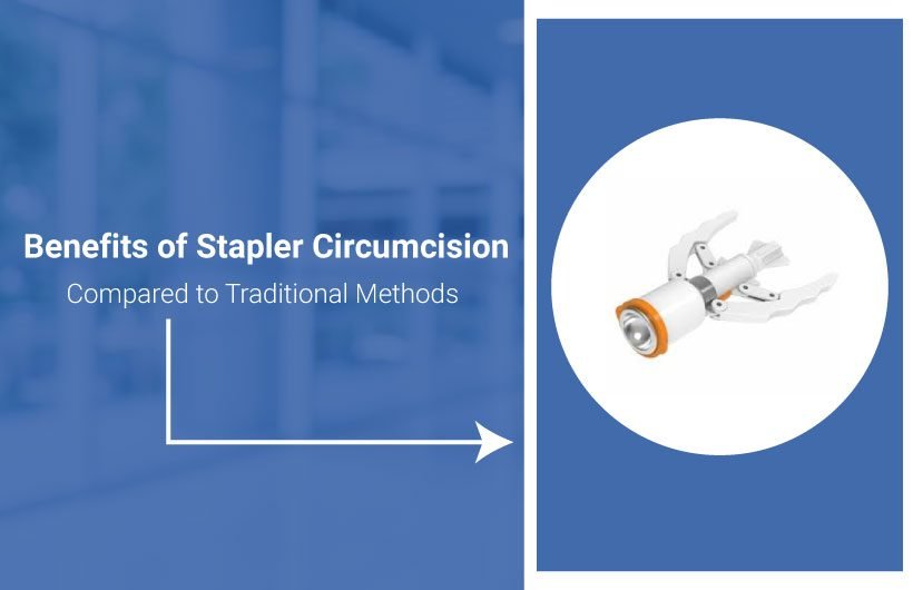 Benefits of Stapler Circumcision