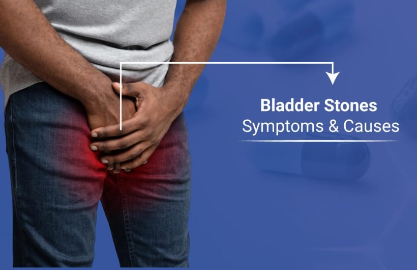 Urinary Bladder Stones