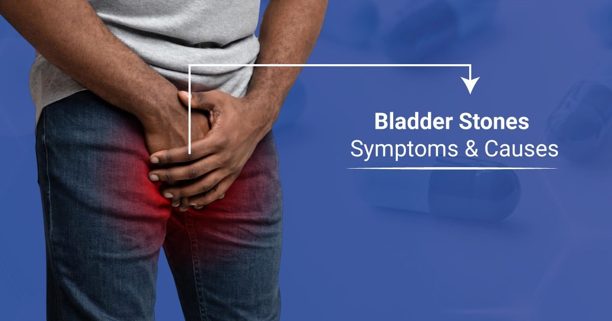 Urinary Bladder Stones