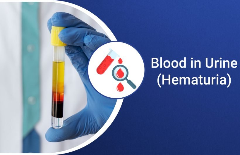 Blood in Urine (Hematuria)