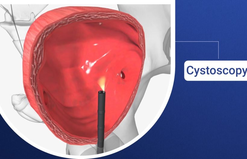 Cystoscopy