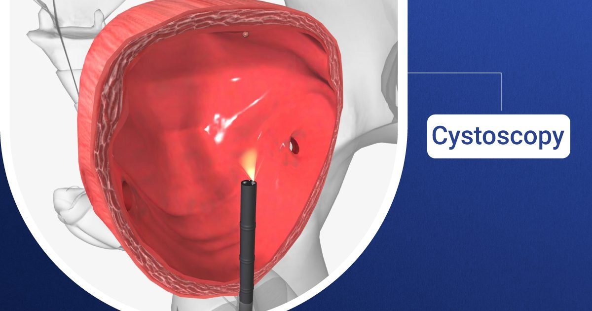 Cystoscopy