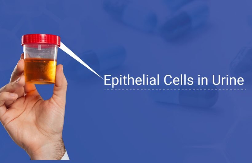 Epithelial Cells urine