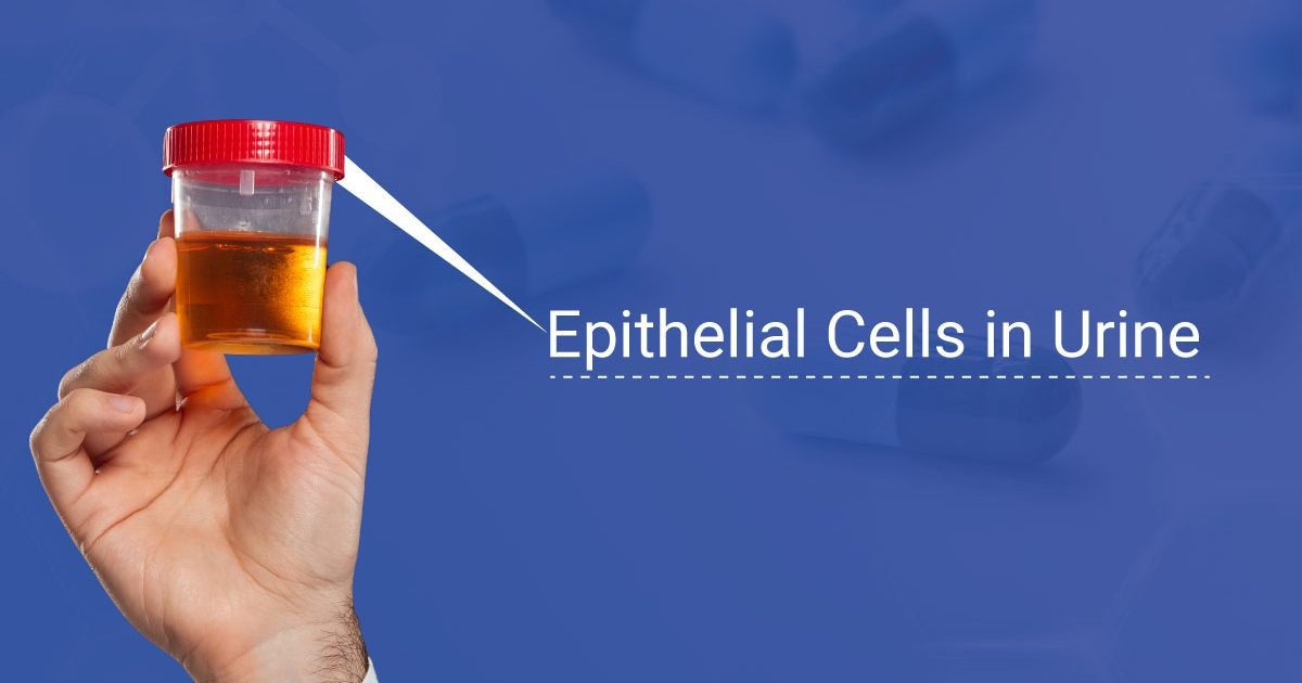 Epithelial Cells urine