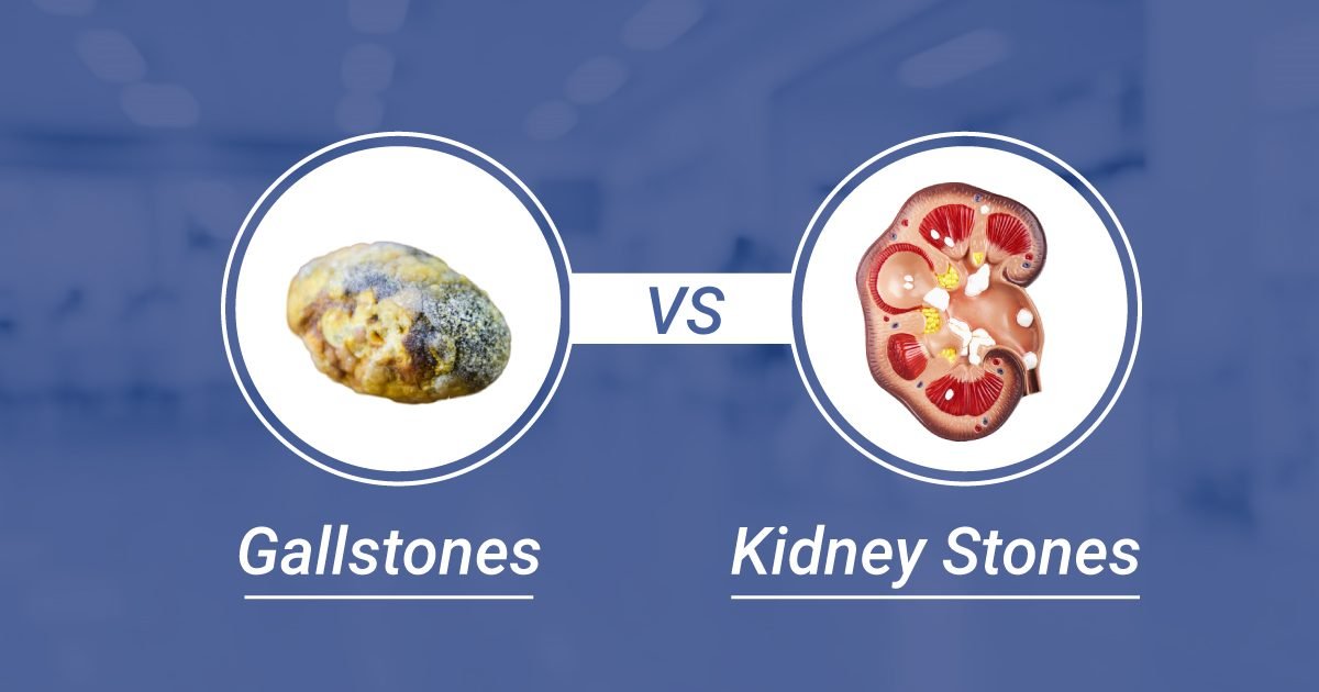 Gallstones vs Kidney Stones