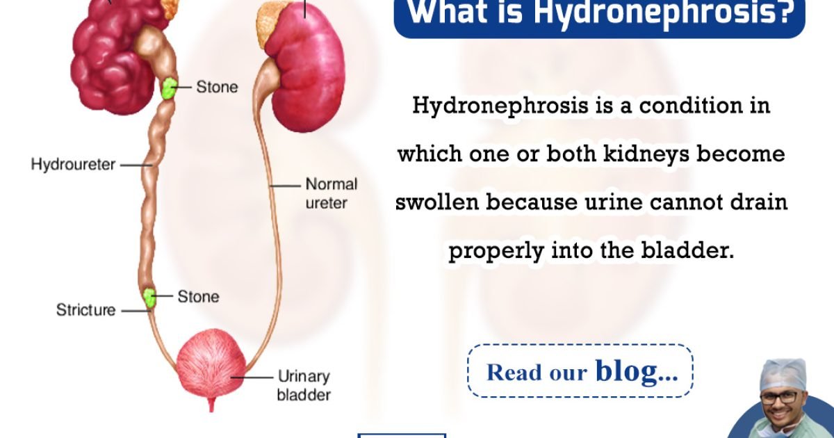 What is Hydronephrosis?