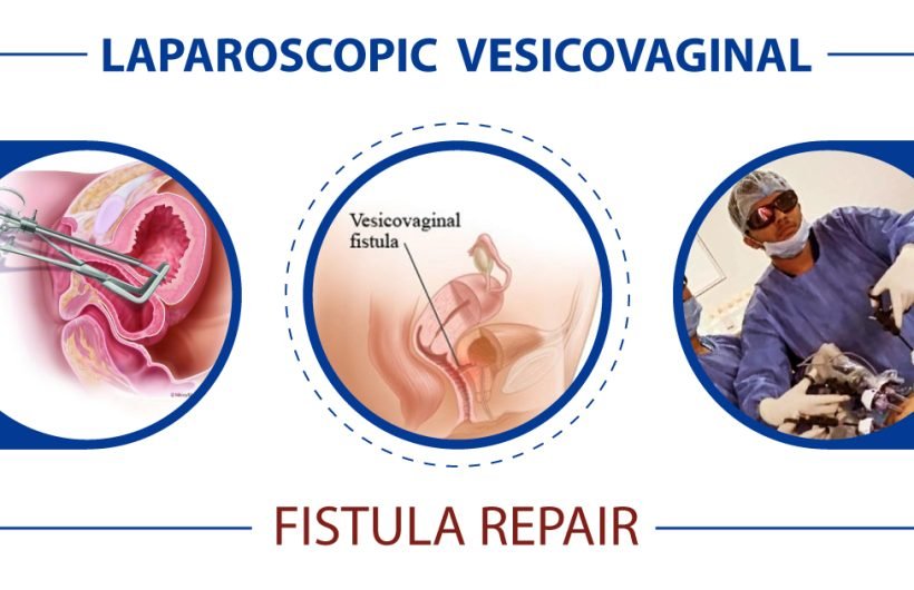 Laparoscopic VVF Repair