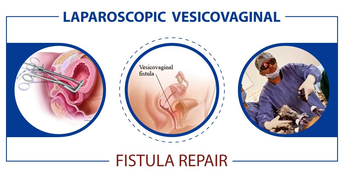 Laparoscopic VVF Repair