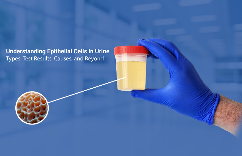 Epithelial Cells in Urine