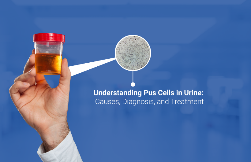 Understanding-puss-cell in urine causes diagnosis and treatments