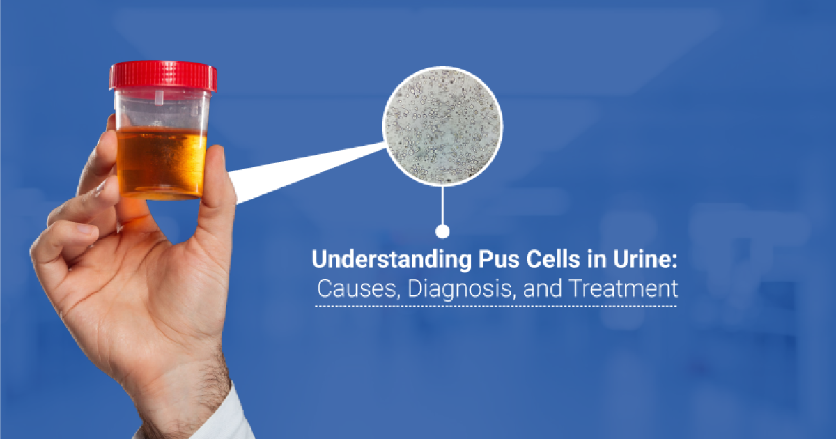 Understanding-puss-cell in urine causes diagnosis and treatments