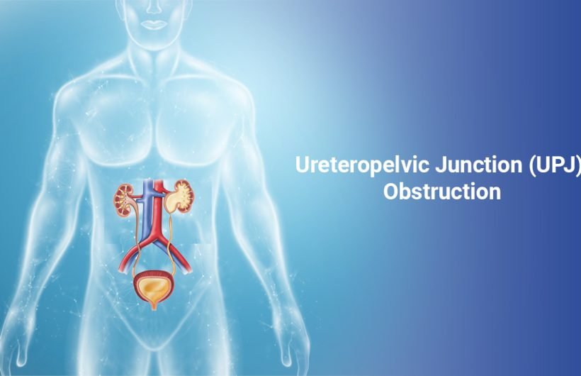 Ureteropelvic Junction (UPJ) Obstruction