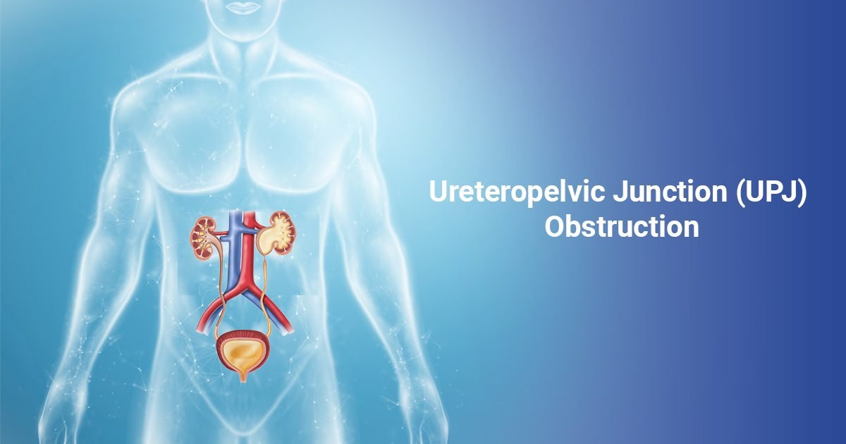 Ureteropelvic Junction (UPJ) Obstruction