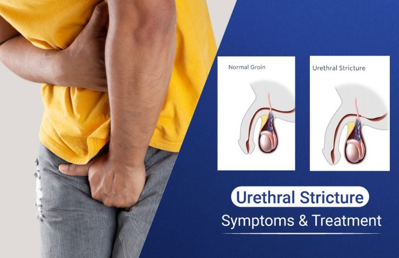 Urethral Stricture