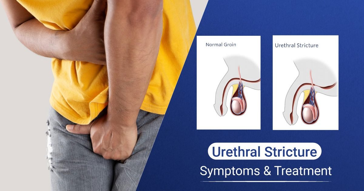 Urethral Stricture