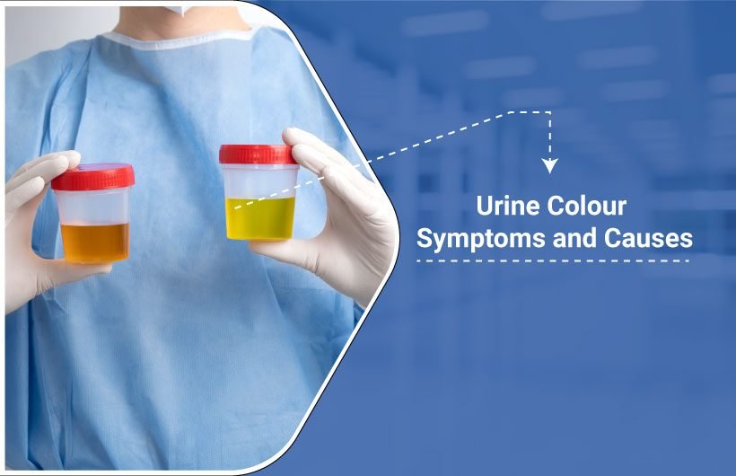 Causes of urine discoloration-Urologist in Dhanbad