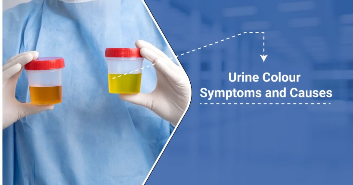 Causes of urine discoloration-Urologist in Dhanbad