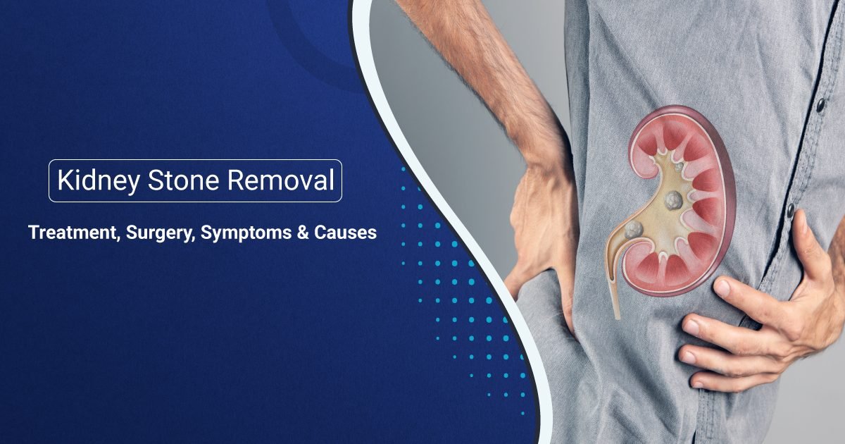 kidney stone removal