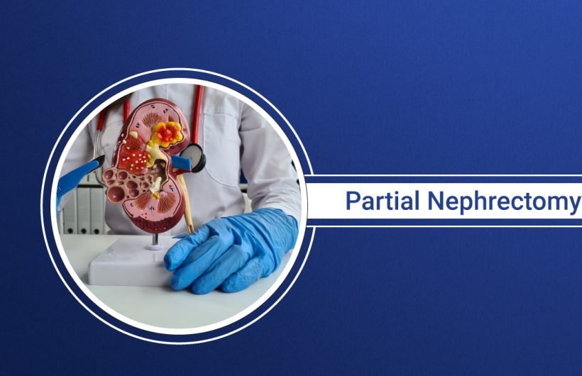 partial-nephrectomy