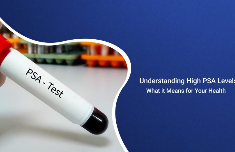 prostate-specific antigen